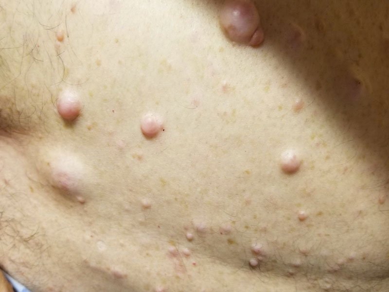 neurofibromatosis damage on the skin