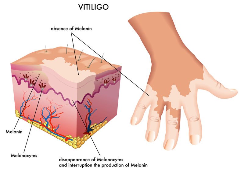 vitiligo slide explanation