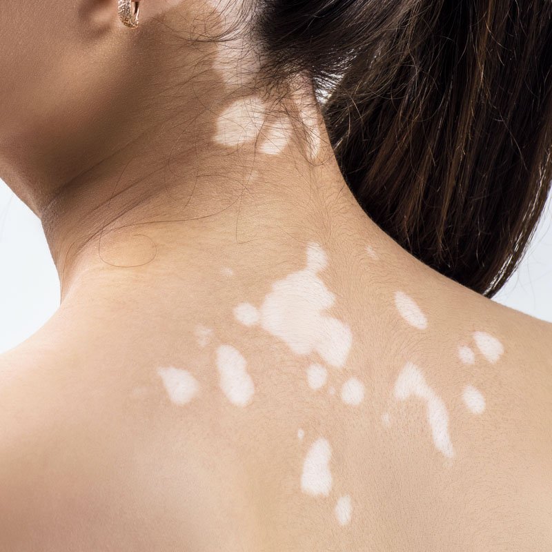 woman back vitiligo stains